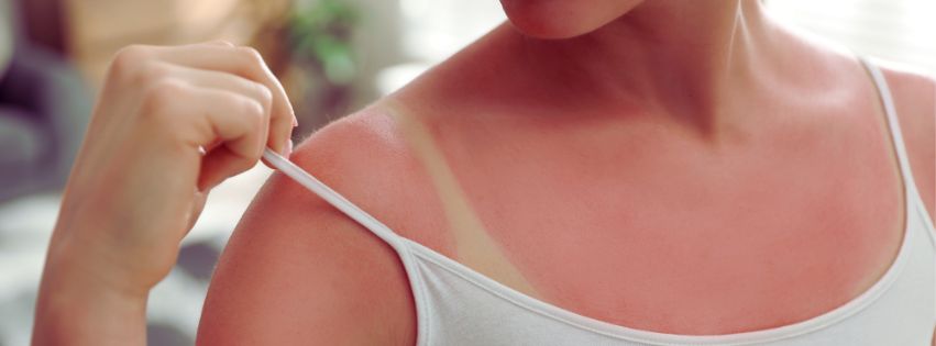sun damaged skin