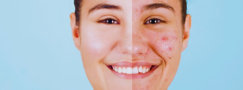 acne and blemish treatment
