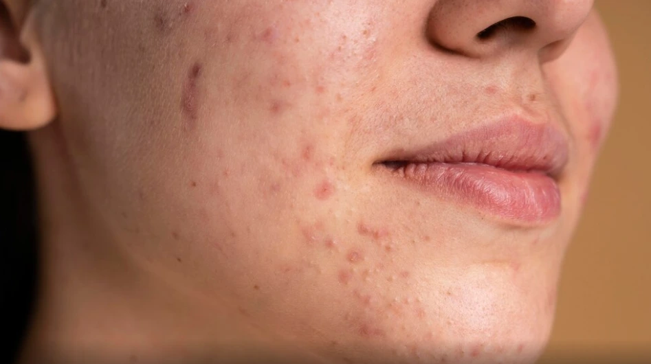 a woman with many pimples