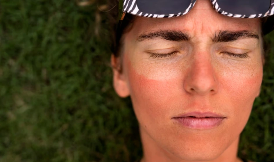 a woman in swim suit with sun burn skin
