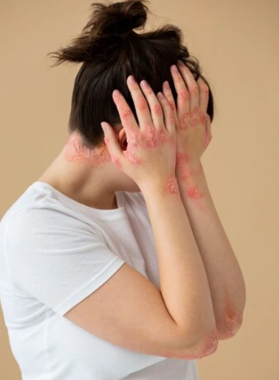 a woman with fungal infection to her hands and neck